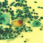 ΄Χαρακτηριστικές ατυπίες έρπητος, σε ολες 